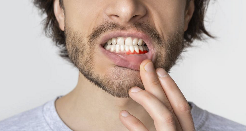 Diş Eti Çekilmesi Neden Olur? Nasıl Tedavi Edilir?